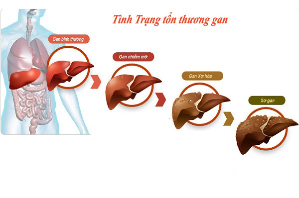 Bệnh xơ gan có chữa được không?