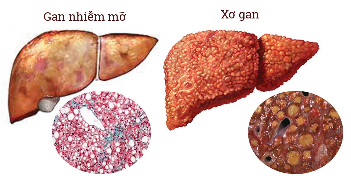 Cách điều trị gan nhiễm mỡ nhanh, hiệu quả, an toàn